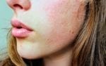 CBD bei Rosacea