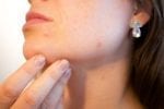 cbd for skin problems