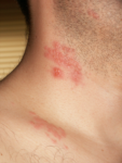 Culebrilla o herpes zóster